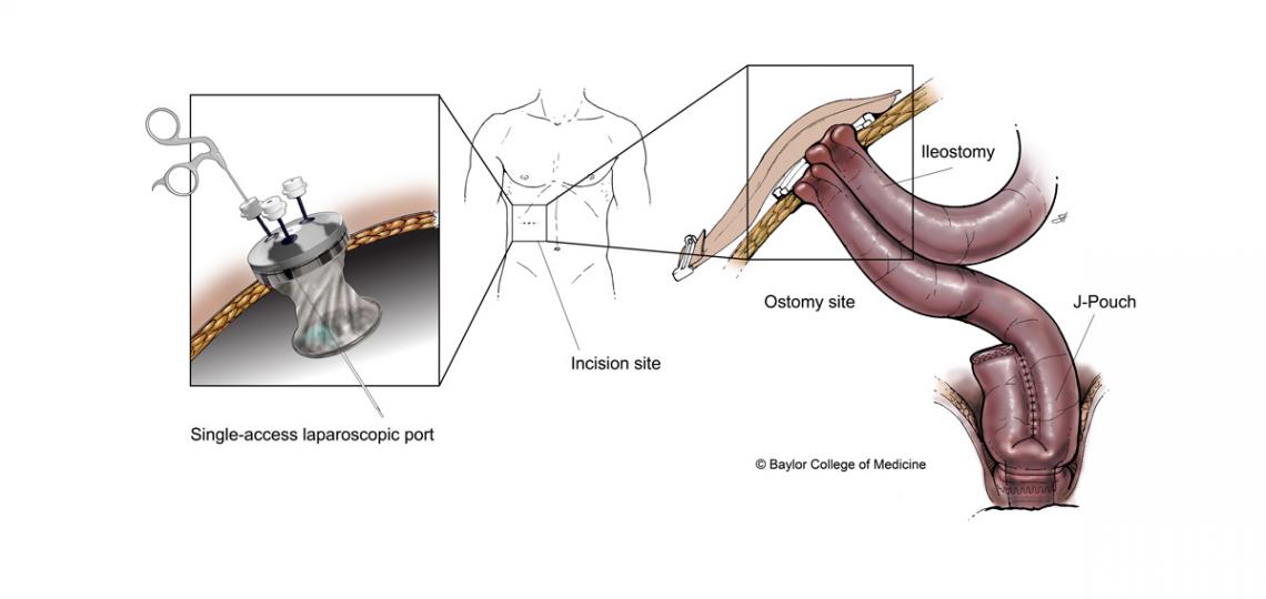 Ileostomy