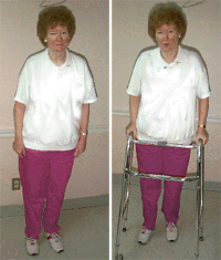 Following embolization, the patient was able to stand and use a walker for short distances