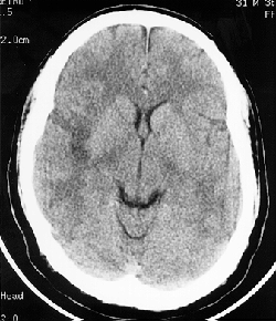 CT of the head without contrast (performed 10 hours after initial symptoms).