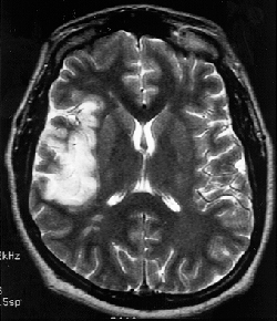 MRI of the brain with and without contrast was obtained. Only the T2 weighted image is illustrated for your diagnostic interpretation.