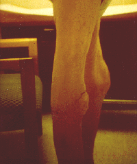 Patient #6's legs.
