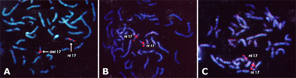 Patient #9 (Figure A), mother (Figure B), and father's (Figure C) chromosomes fluorescently labeled with a marker near the centromere for the 17th chromosomes delineates the 17th chromosomes with a bright orange label. Near the end of the short arm of the 17th chromosomes another marker for the region of the LIS-1 gene is shown with a fainter signal. The chromosomes delineated as 