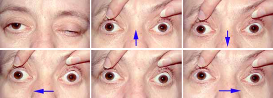 The patient is asked to look in the various positions of gaze, as indicated by the arrows.