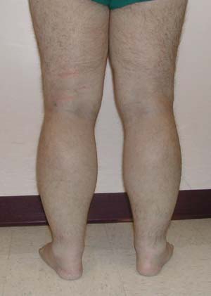 Marked non-pitting edema up to the mid to proximal forearm and proximal calves.