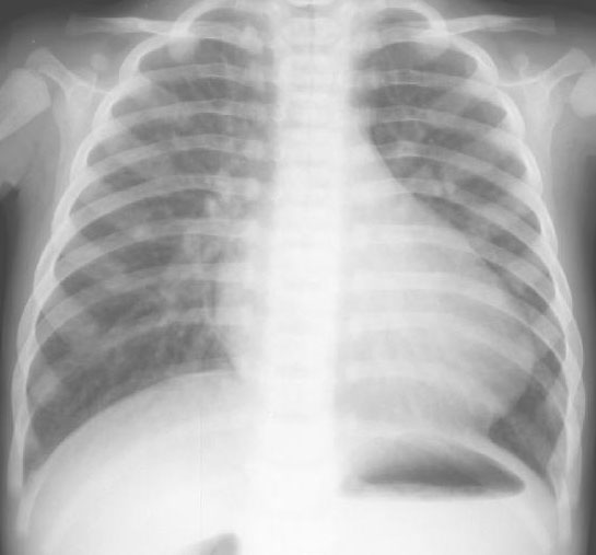 Plain Radiographic Diagnosis Of Congenital Heart Disease