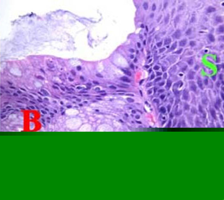 Unlocking the mystery behind Barrett’s esophagus