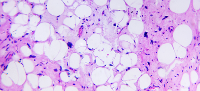 Cancer Cells