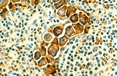 Human metastatic breast cancer cells in lymph nodes. 