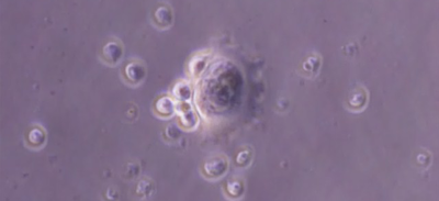 Photomicrograph of HER2 targeting T cells seeking, engaging and killing human medulloblastoma cells.