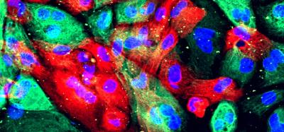 prostate cancer cells