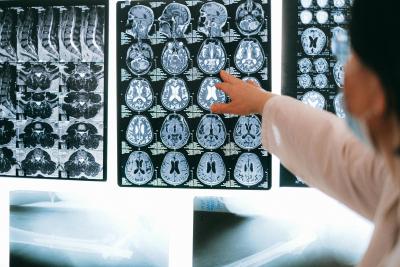 Photo of a doctor pointing to brain scans on a light box