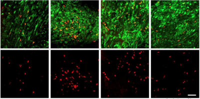 Staining of glioma cells from mice in a methionine-restriced diet helped researchers notice that the DNA inside the tumors appears partially unraveled rather than the usual compact organization. 