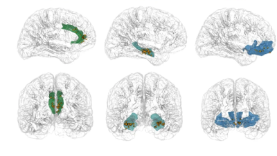 Drawings of brain sections showing colored areas to indicate brain activity