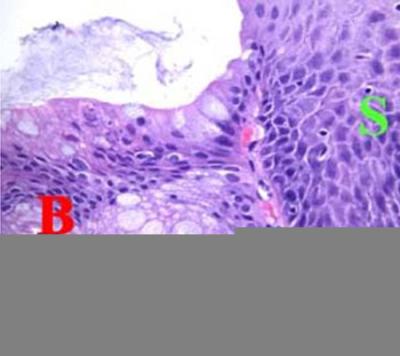 Barrett's metaplasia under the microscope