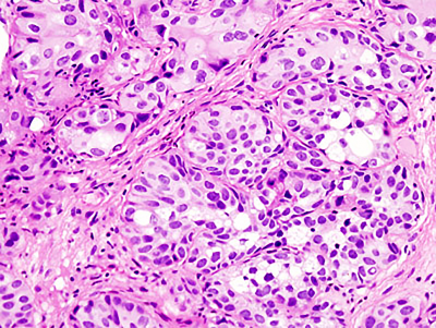 How genomics profiling can help identify the best treatment for bladder cancer