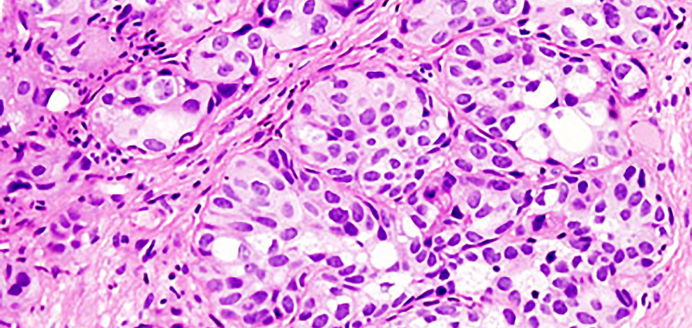 Understanding What Makes Some Bladder Cancers Resistant to Chemotherapy