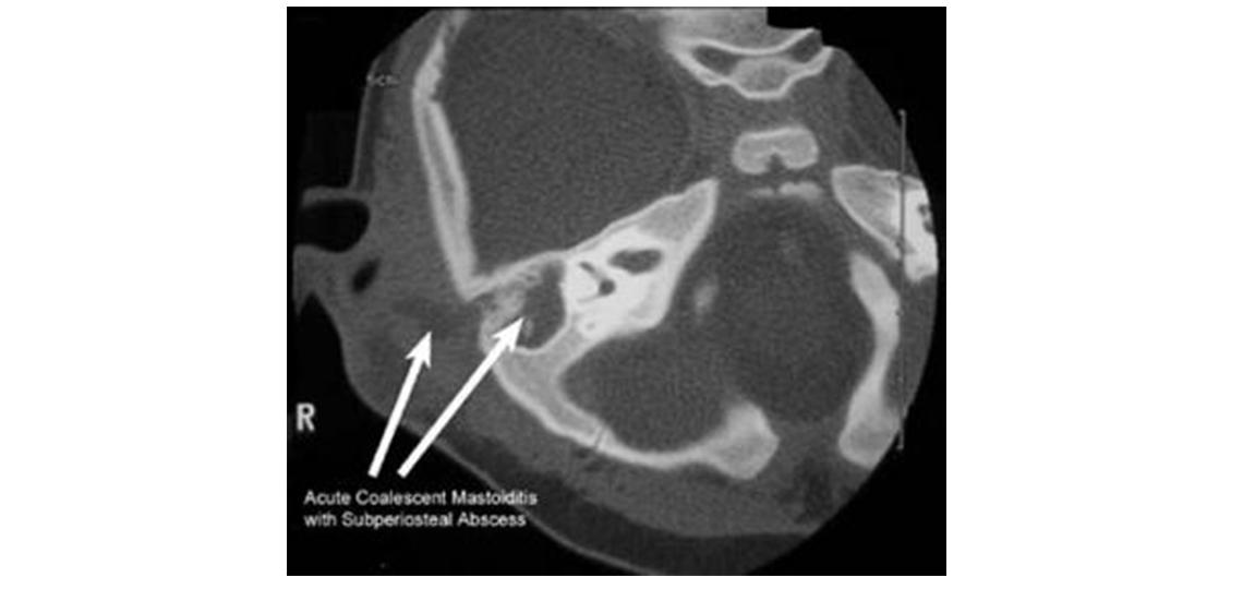 CT scan of acute coalescent mastoiditis with subperiosteal abscess