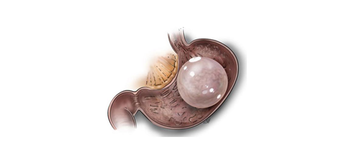 Intragastric balloon
