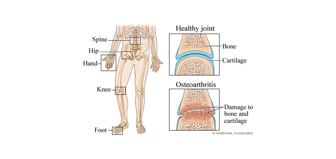 Osteoarthritis Baylor Medicine Knee arthritis is known to affect joint functionality causing knee pain and even leading to disability as it progresses. osteoarthritis baylor medicine