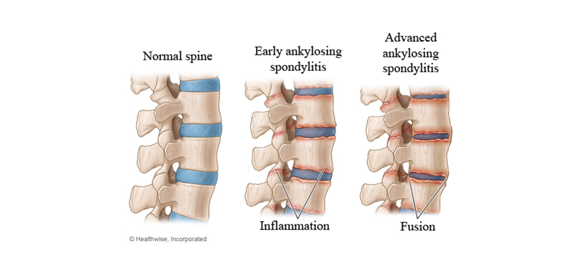 Spondylarthritis