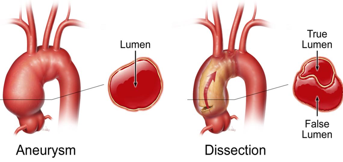 Aneurysm VS Dissect Arch