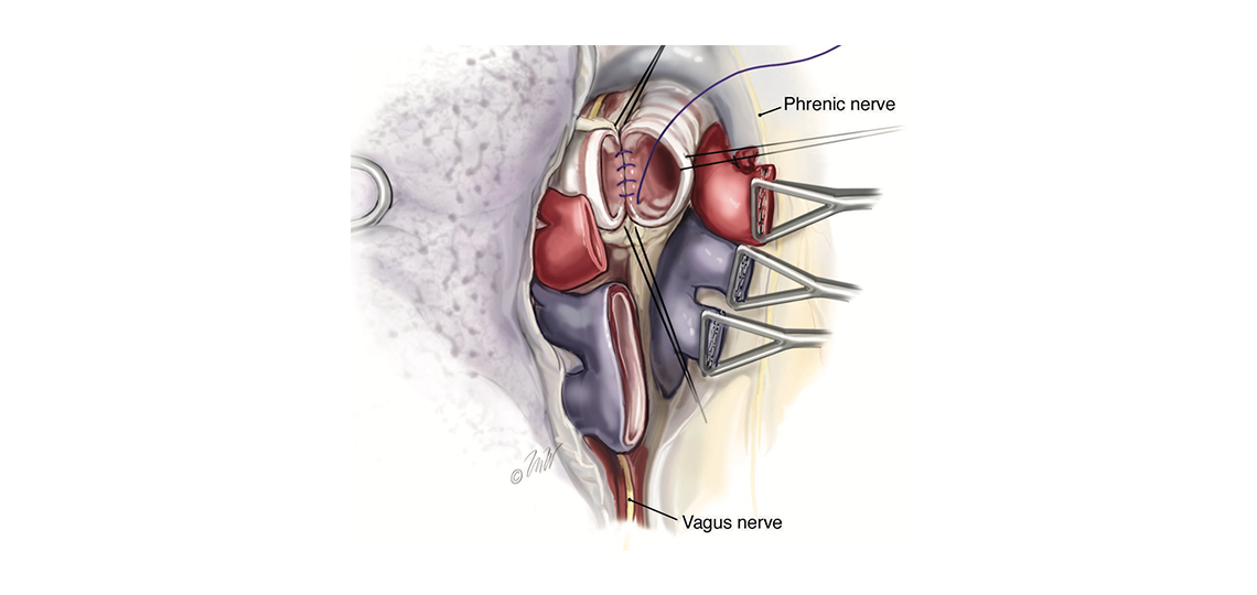 adult chest surgery at Baylor Medicine