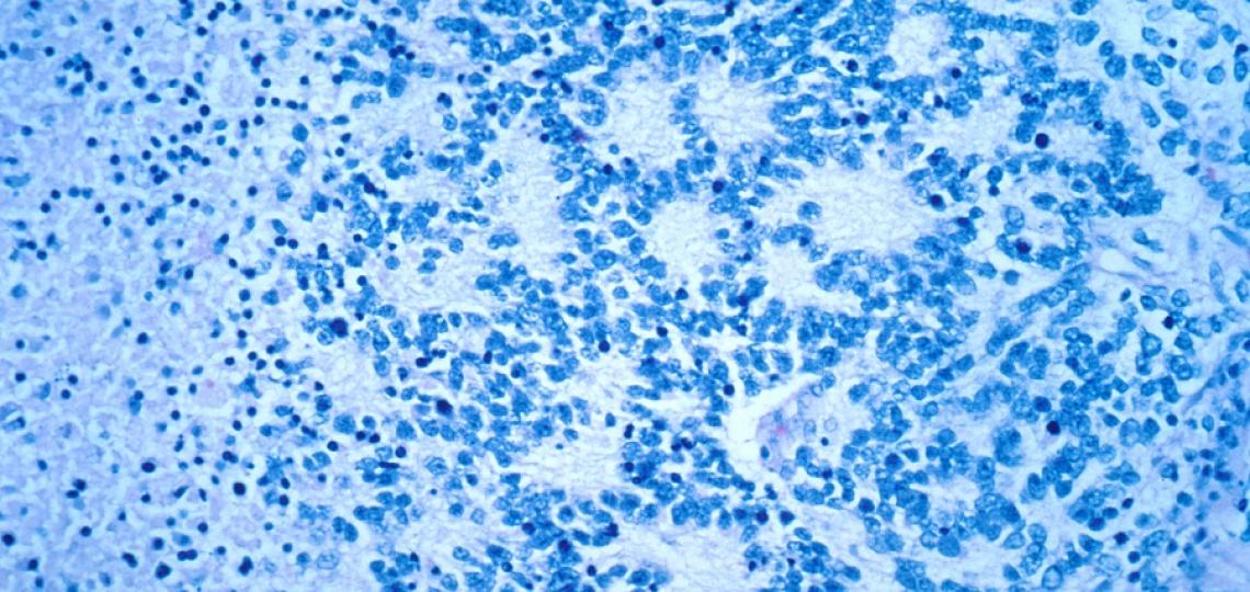 A microscopy image of a typical neuroblastoma