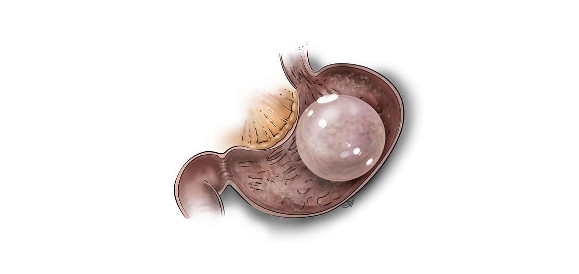 Gastric balloon illustration