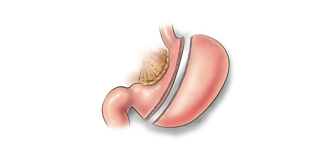 Gastric Sleeve Surgery Baylor Medicine