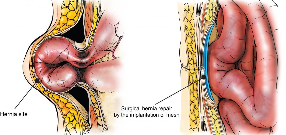 Newly designed 3-D printed Biomesh minimizes postsurgical complications of hernia repair in an animal model