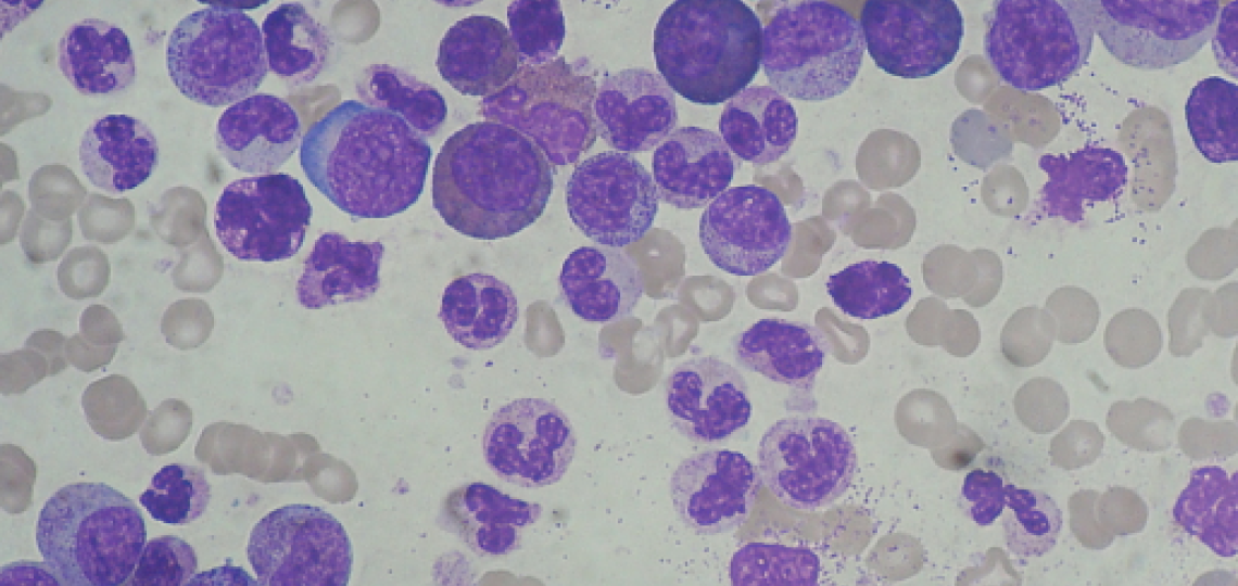 Chronic Myeloid Leukemia Smear