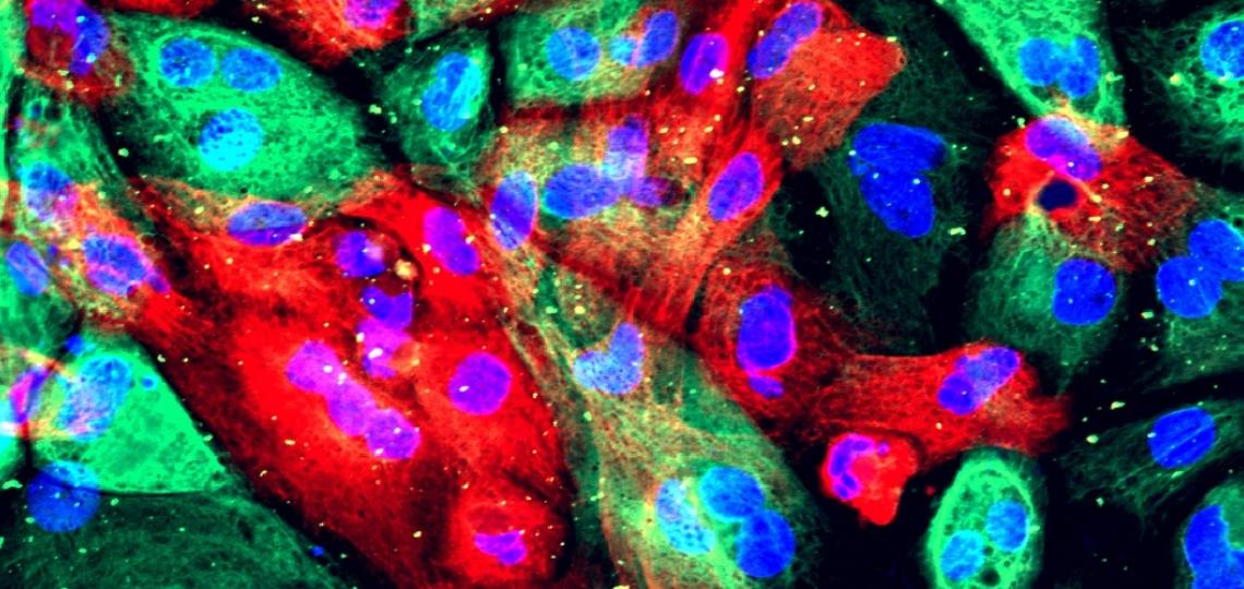 A microscopy image of prostate cancer cells.