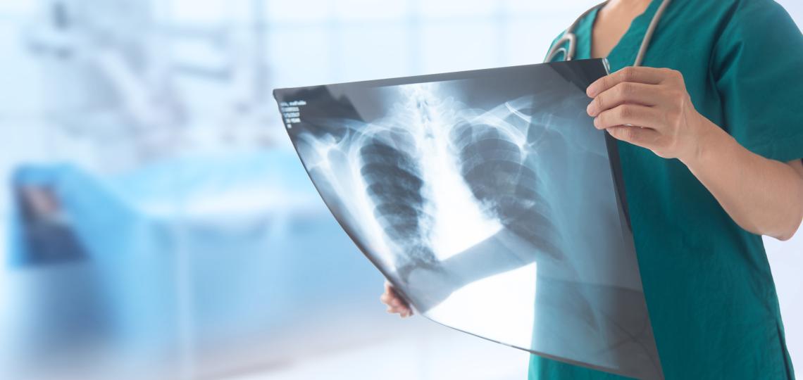 Doctor holding an x ray of a patients lungs.