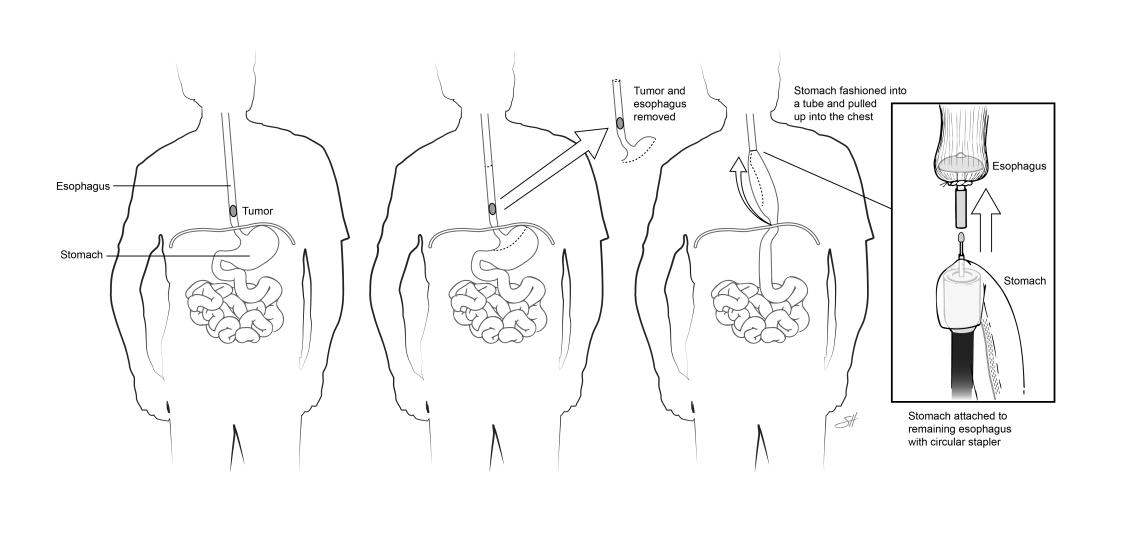 Esophagectomy