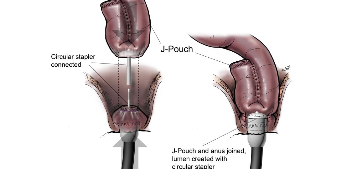 J pouch colorectal stapler