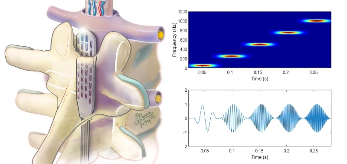 Spinal cord stimulation