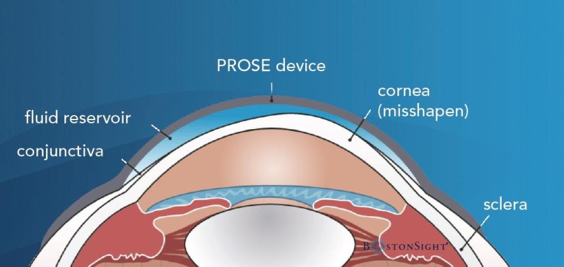 PROSE device illustration