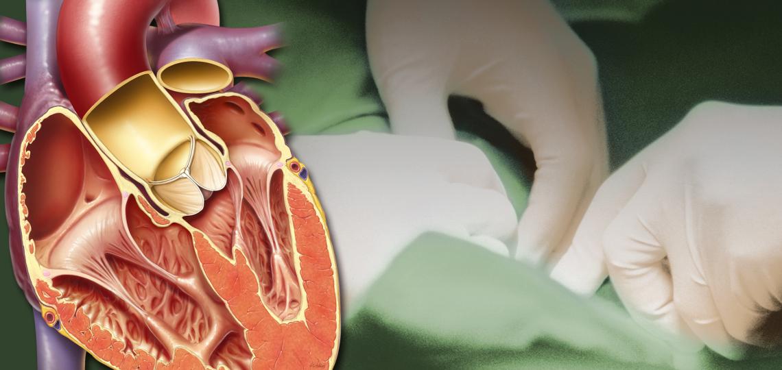 Current Trends in Aortic and Cardiovascular Therapy