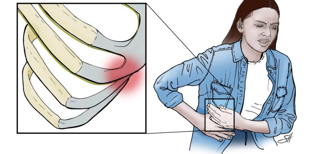 Illustration depicting rubbing rib syndrome