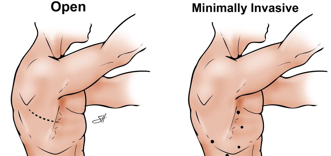 Illustration depicting the entry points for open and minimally invasive lung resection procedures.