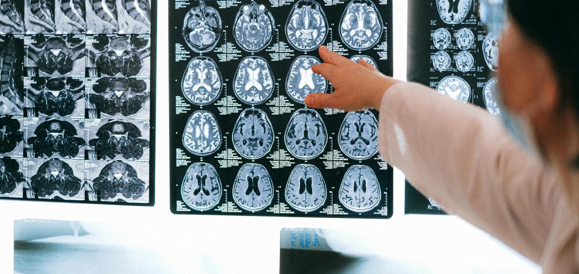 Photo of a doctor pointing to brain scans on a light box