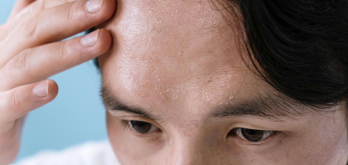 Close up photo of a man's forehead sweating