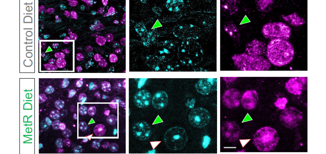 The image shows staining of glioma cells from mice in a methionine-restriced diet which helped researchers notice that the DNA inside the tumors appears partially unraveled rather than the usual compact organization. 