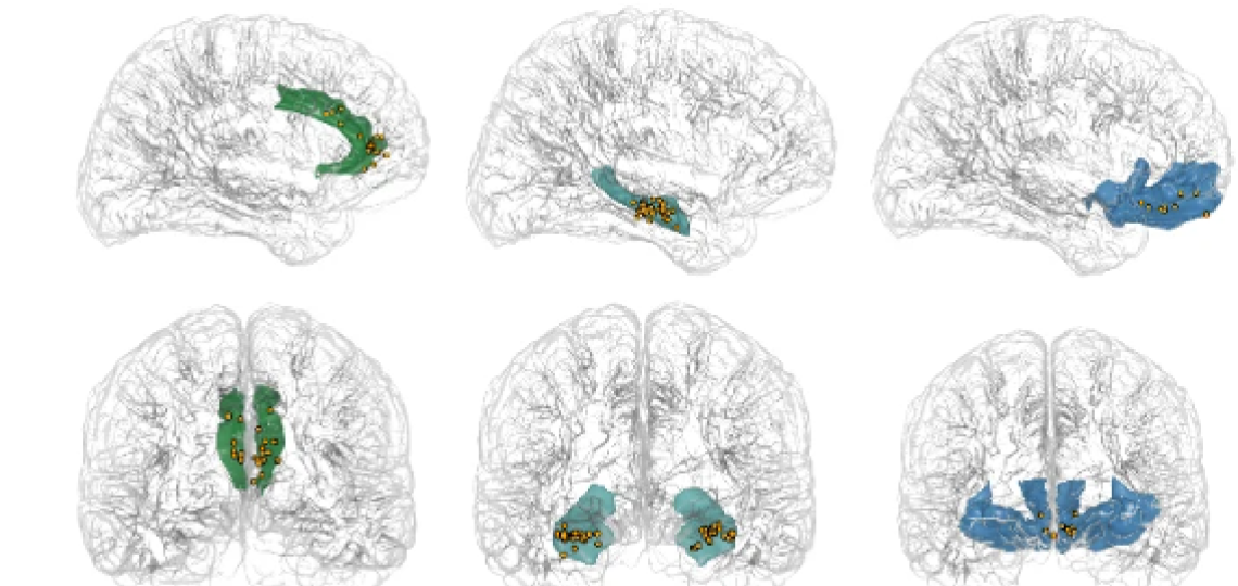 Drawings of brain sections showing colored areas to indicate brain activity