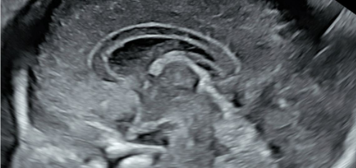 Fetal Brain Neurosono OBGYN