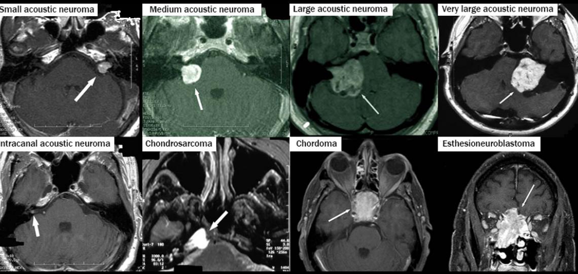 Acoustic Neuromas and Skull Base Surgery