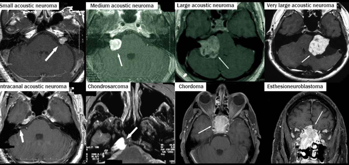 Acoustic Neuromas and Skull Base Surgery