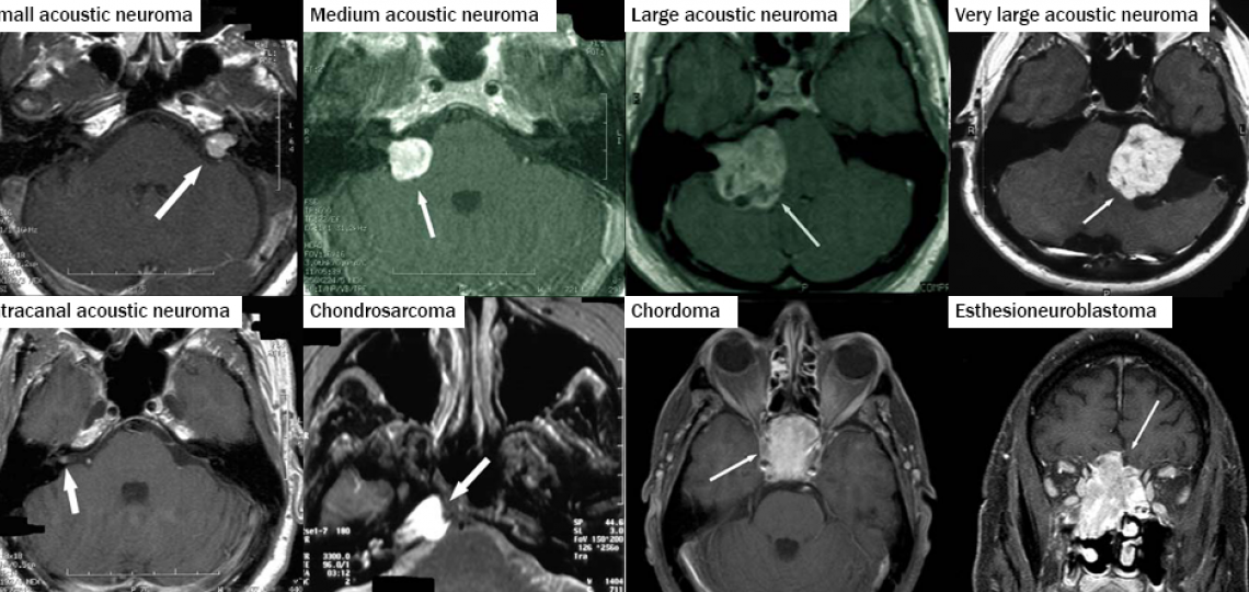 Acoustic Neuroma and Skull Base Surgery Photographs 1