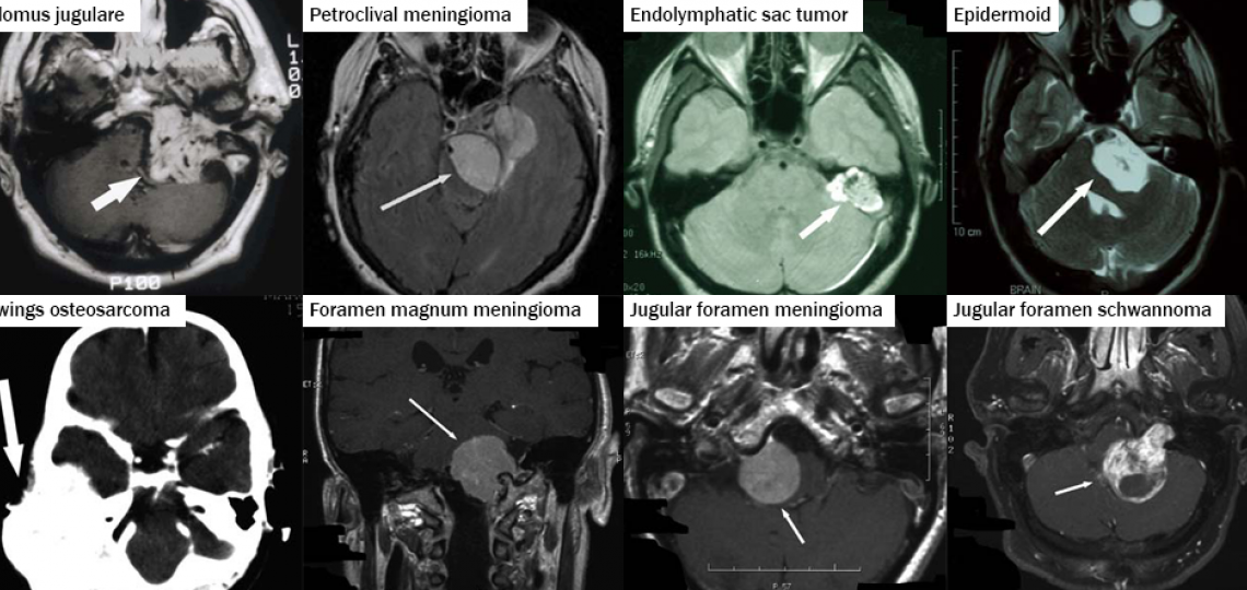 Acoustic Neuroma and Skull Base Surgery Photographs 2
