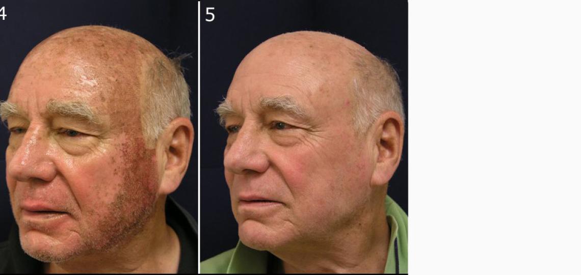 (4) Four days after Active FX laser treatment. (5) 10 days after second laser treatment.
